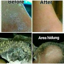 Masker komedo